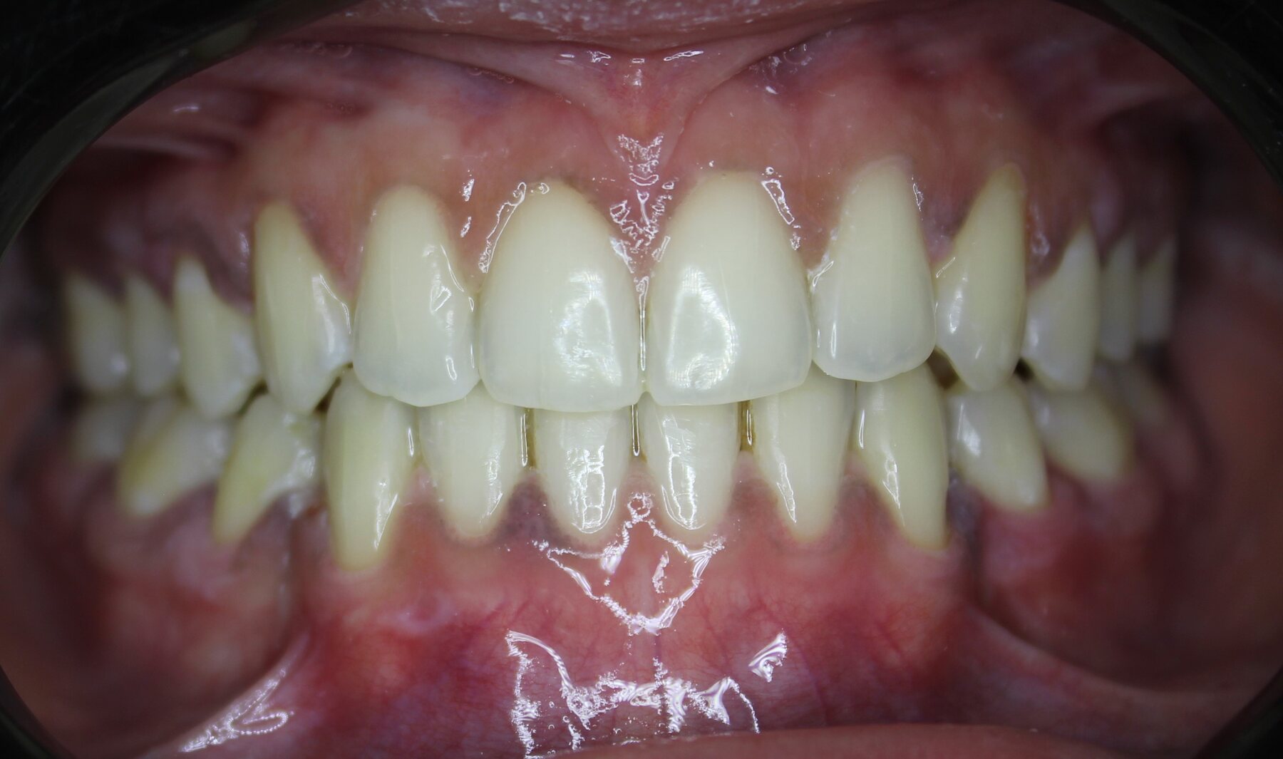 Advanced Case 01 Front after treatment