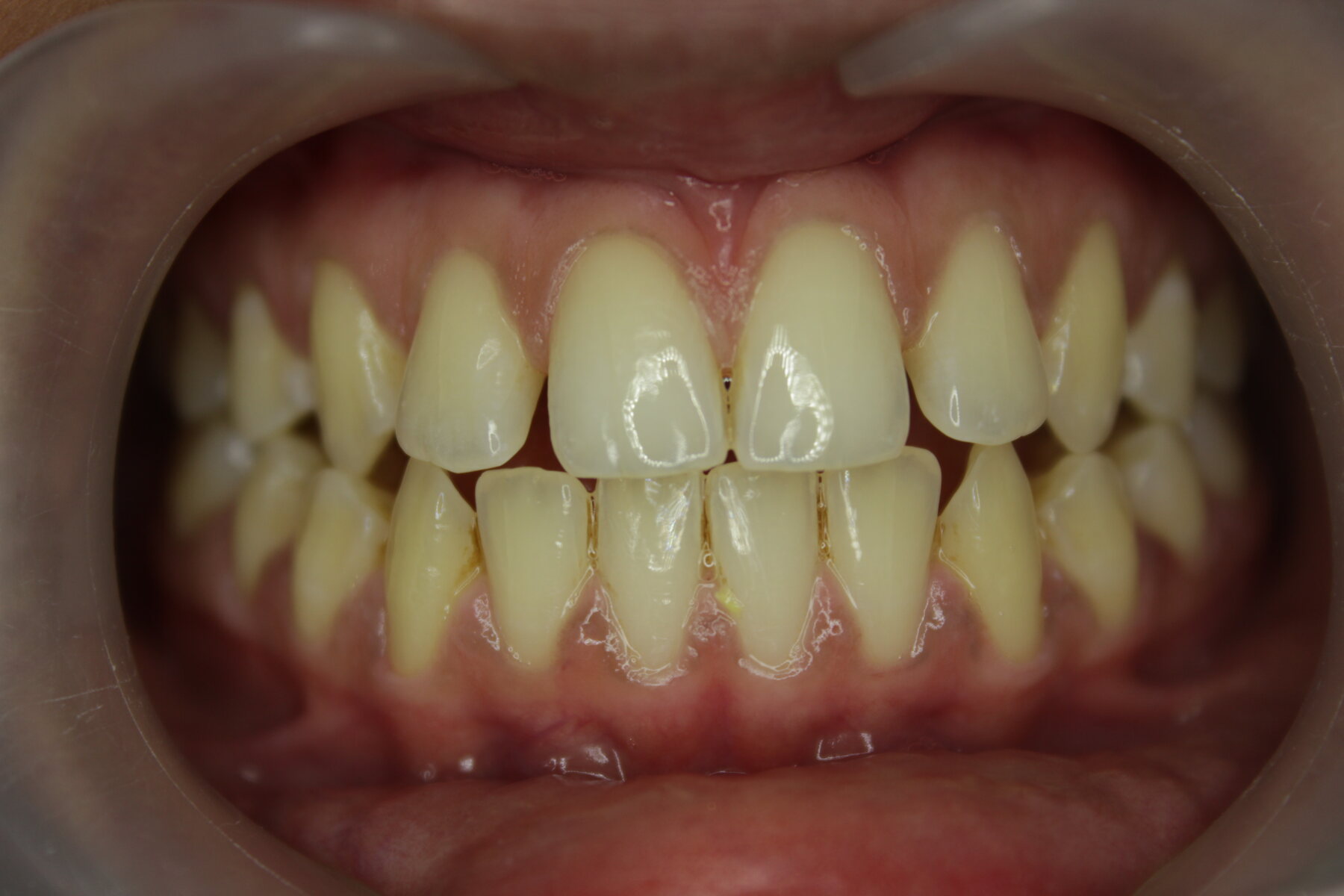 Advanced Case 01 Front before treatment