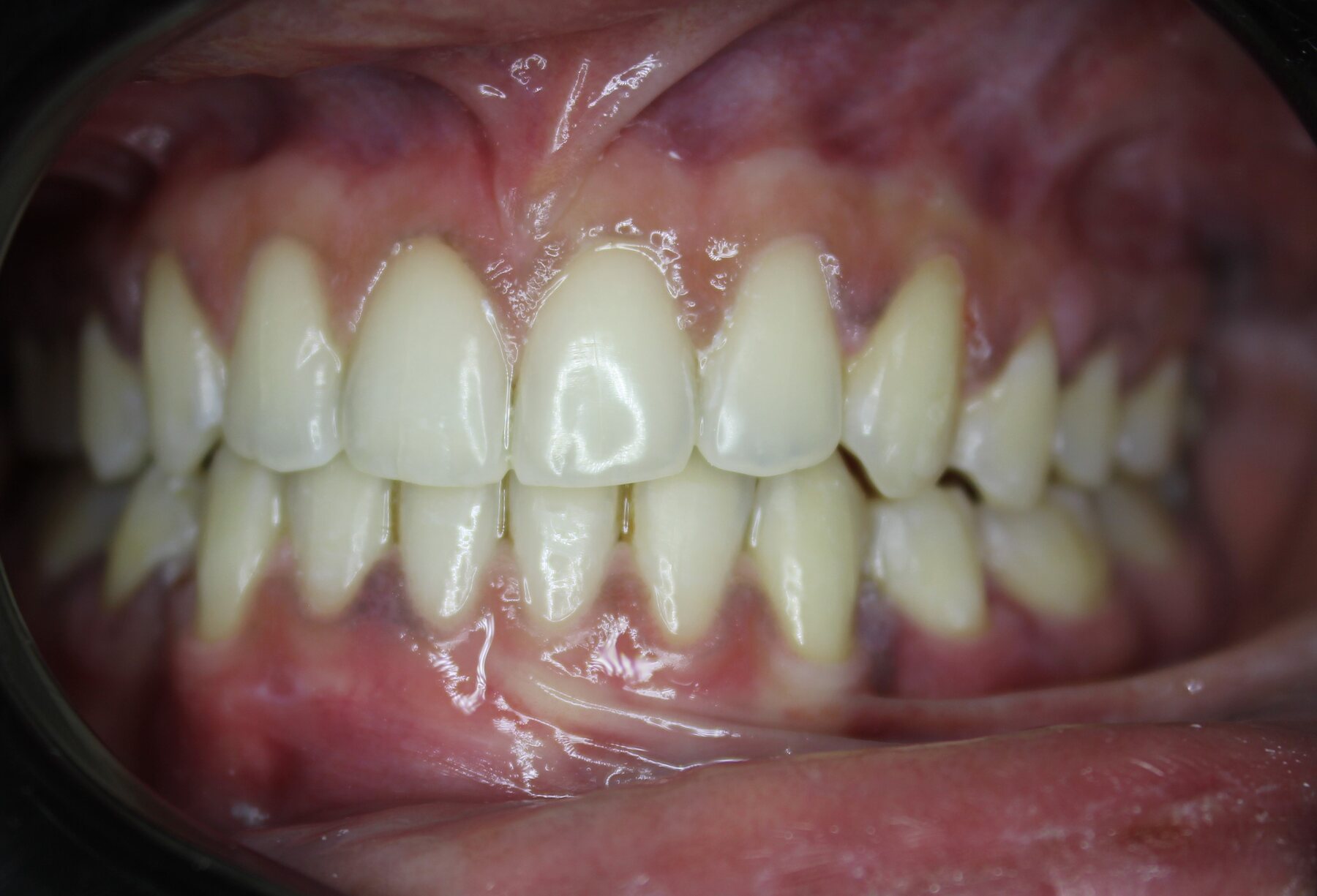 Advanced Case 01 Left after treatment