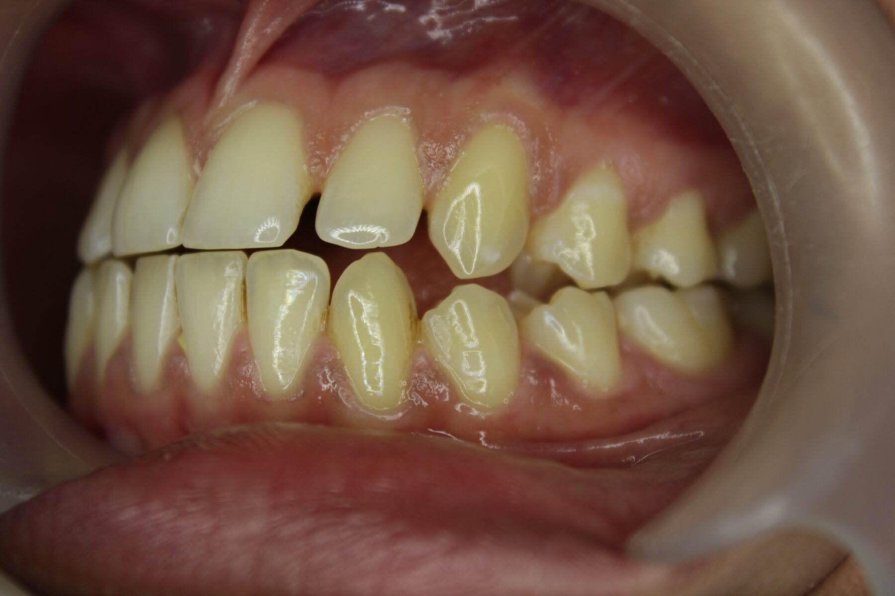 Advanced Case 01 Left before treatment