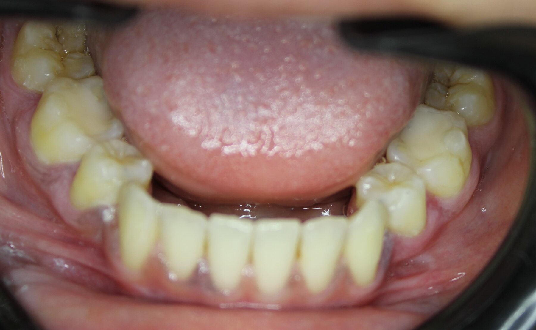 Advanced Case 01 Lower before treatment