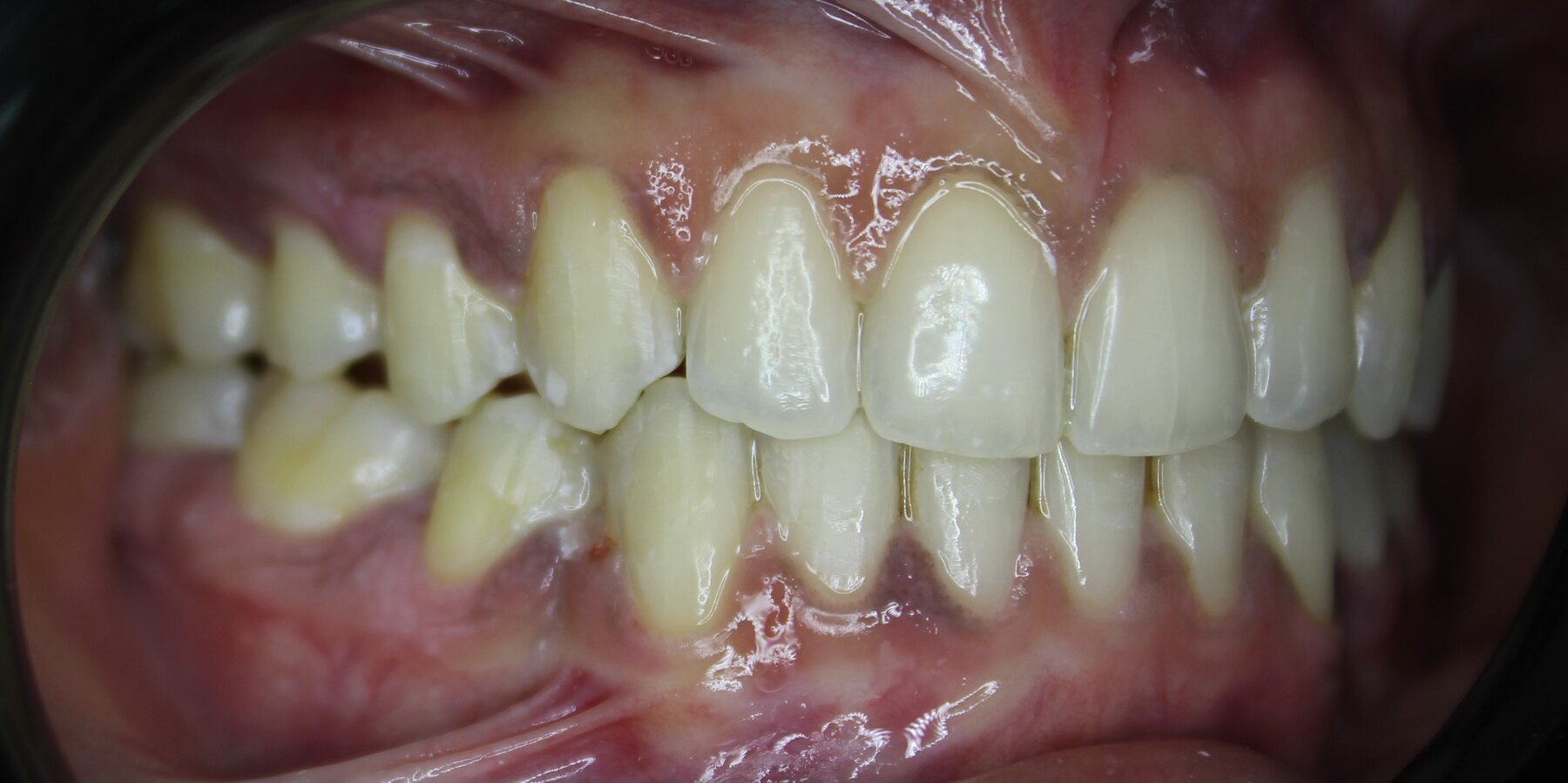 Advanced Case 01 Right after treatment