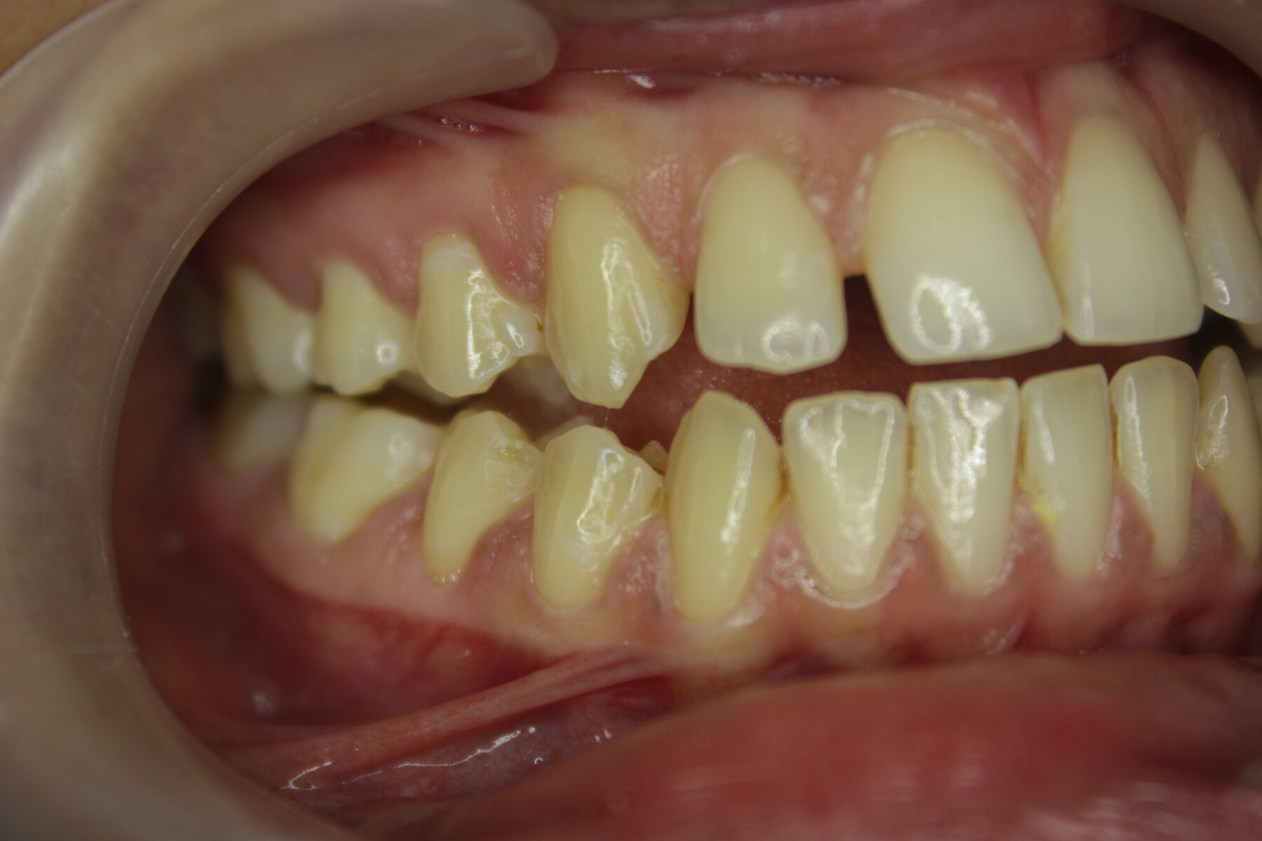 Advanced Case 01 Right before treatment