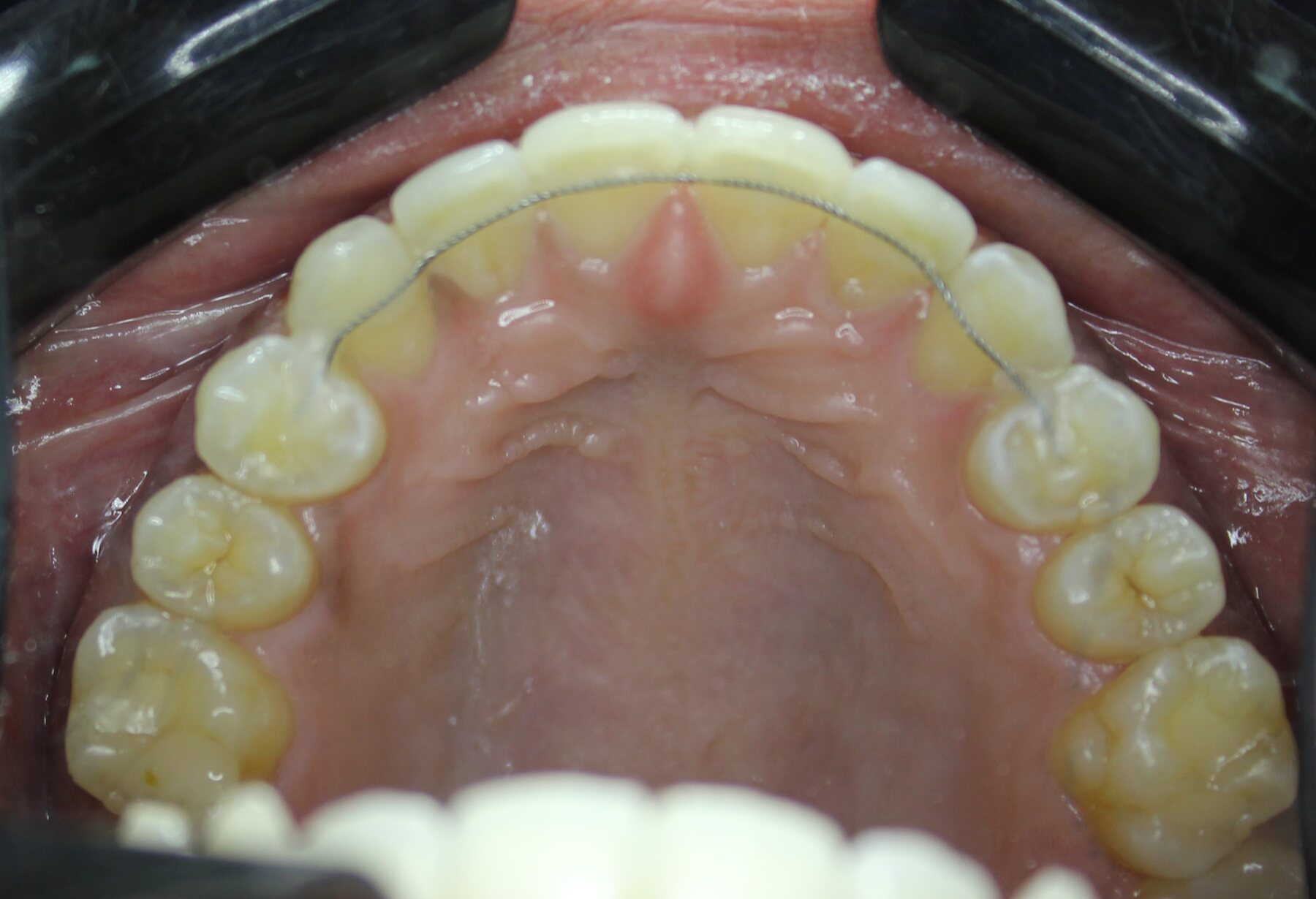 Advanced Case 01 Upper after treatment