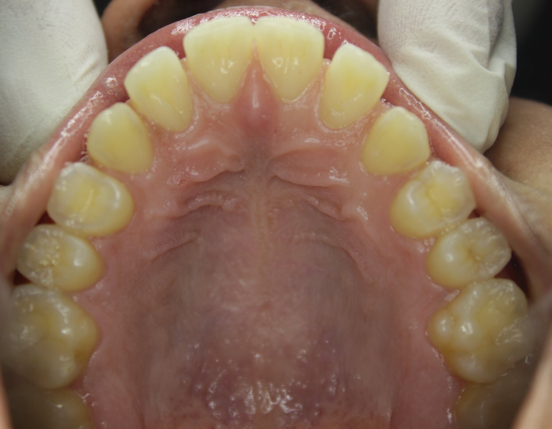 Advanced Case 01 Upper before treatment