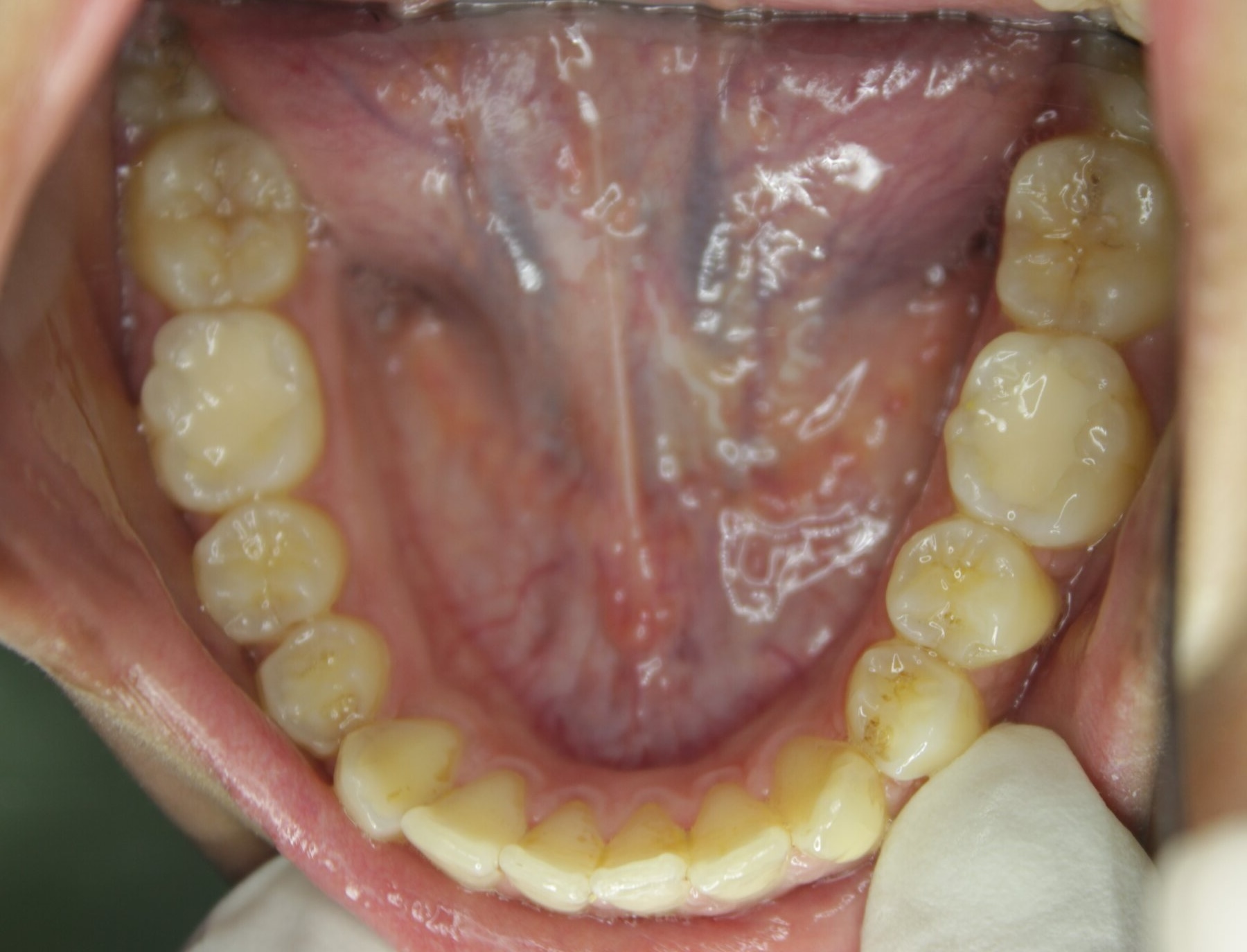 Advanced Case 01 Lower after treatment